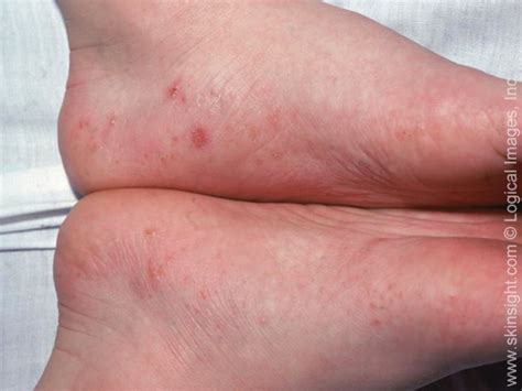 dyshidrotic eczema between toes The most common location of dyshidrotic eczema is on the hands and, less commonly, the feet